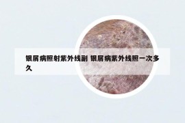 銀屑病照射紫外線副 銀屑病紫外線照一次多久