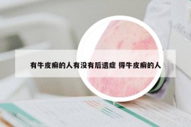有牛皮癬的人有沒有后遺癥 得牛皮癬的人