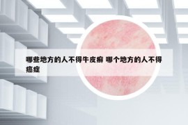 哪些地方的人不得牛皮癬 哪個地方的人不得癌癥