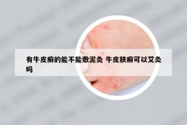 有牛皮癬的能不能敷泥灸 牛皮膚癬可以艾灸嗎