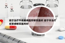 南寧治療牛皮癬病醫(yī)院哪家最好 南寧市治療皮膚病哪家醫(yī)院好