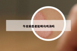 牛皮癬患者能喝烏雞湯嗎