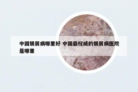 中國銀屑病哪里好 中國最權(quán)威的銀屑病醫(yī)院是哪里