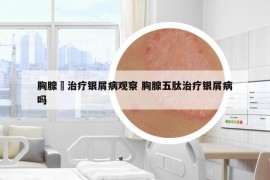 胸腺舦治療銀屑病觀察 胸腺五肽治療銀屑病嗎