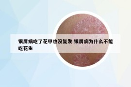 銀屑病吃了花甲也沒復(fù)發(fā) 銀屑病為什么不能吃花生