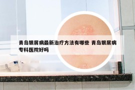 青島銀屑病最新治療方法有哪些 青島銀屑病?？漆t(yī)院好嗎