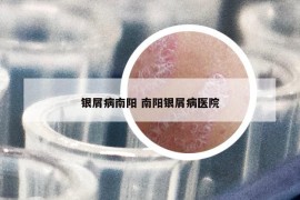 銀屑病南陽 南陽銀屑病醫(yī)院
