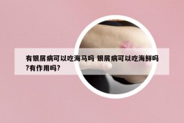 有銀屑病可以吃海馬嗎 銀屑病可以吃海鮮嗎?有作用嗎?