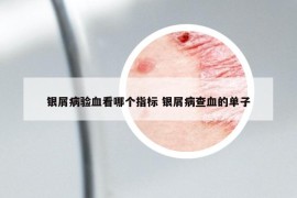 銀屑病驗血看哪個指標 銀屑病查血的單子