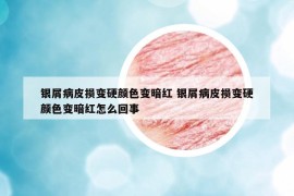 銀屑病皮損變硬顏色變暗紅 銀屑病皮損變硬顏色變暗紅怎么回事