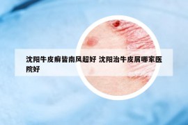 沈陽(yáng)牛皮癬皆南風(fēng)超好 沈陽(yáng)治牛皮屑哪家醫(yī)院好