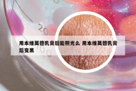 用本維莫德乳膏后能照光么 用本維莫德乳膏后變黑