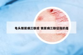 龜頭銀屑病三聯(lián)癥 銀屑病三聯(lián)征指的是
