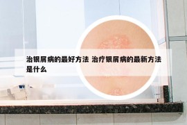 治銀屑病的最好方法 治療銀屑病的最新方法是什么