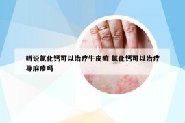 聽說(shuō)氯化鈣可以治療牛皮癬 氯化鈣可以治療蕁麻疹嗎
