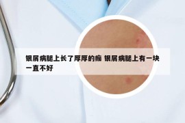 銀屑病腿上長(zhǎng)了厚厚的痂 銀屑病腿上有一塊一直不好