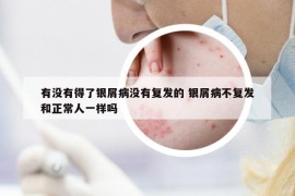 有沒(méi)有得了銀屑病沒(méi)有復(fù)發(fā)的 銀屑病不復(fù)發(fā)和正常人一樣嗎