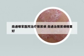 南通哪家醫(yī)院治療銀屑病 南通治銀屑病哪里好