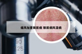 痛風(fēng)加重銀屑病 銀屑病風(fēng)濕病