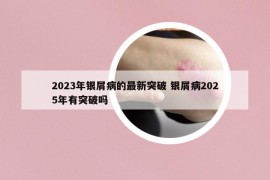 2023年銀屑病的最新突破 銀屑病2025年有突破嗎