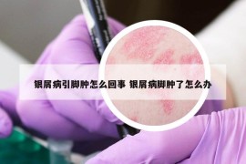 銀屑病引腳腫怎么回事 銀屑病腳腫了怎么辦