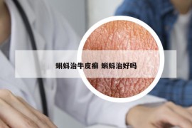 蝌蚪治牛皮癬 蝌蚪治好嗎