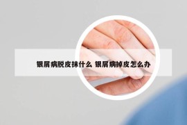 銀屑病脫皮抹什么 銀屑病掉皮怎么辦