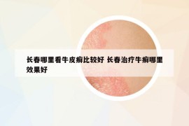 長(zhǎng)春哪里看牛皮癬比較好 長(zhǎng)春治療牛癬哪里效果好