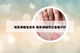 銀屑病睡覺(jué)床單 銀屑病睡熱還是睡冷好