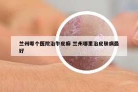 蘭州哪個醫(yī)院治牛皮癬 蘭州哪里治皮膚病最好