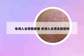 非洲人會(huì)得銀屑病 非洲人會(huì)得皮膚癌嗎