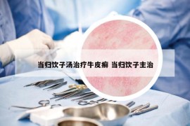 當(dāng)歸飲子湯治療牛皮癬 當(dāng)歸飲子主治