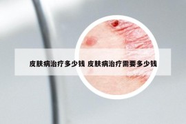 皮膚病治療多少錢 皮膚病治療需要多少錢