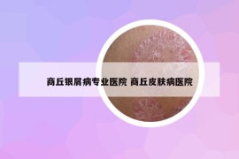 商丘銀屑病專(zhuān)業(yè)醫(yī)院 商丘皮膚病醫(yī)院