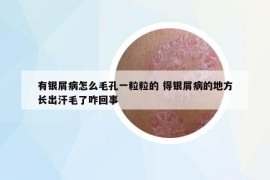有銀屑病怎么毛孔一粒粒的 得銀屑病的地方長出汗毛了咋回事