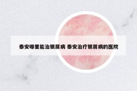 泰安哪里能治銀屑病 泰安治療銀屑病的醫(yī)院