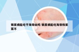 銀屑病能吃干海帶絲嗎 銀屑病能吃海帶和紫菜不