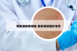 銀屑病撤銷婚姻 銀屑病結(jié)婚好難受