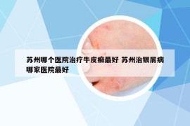 蘇州哪個醫(yī)院治療牛皮癬最好 蘇州治銀屑病哪家醫(yī)院最好
