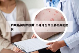 白斑最初期的圖片 小兒牙齒白斑最初期的圖片