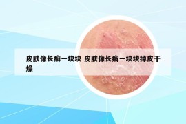 皮膚像長癬一塊塊 皮膚像長癬一塊塊掉皮干燥