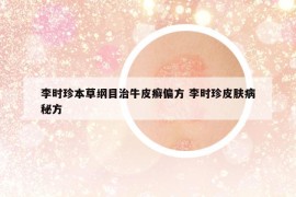 李時(shí)珍本草綱目治牛皮癬偏方 李時(shí)珍皮膚病秘方