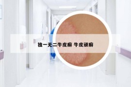 獨一無二牛皮癬 牛皮頑癬