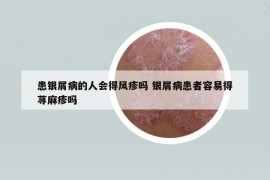 患銀屑病的人會得風疹嗎 銀屑病患者容易得蕁麻疹嗎