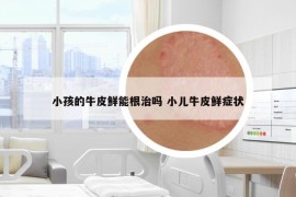 小孩的牛皮鮮能根治嗎 小兒牛皮鮮癥狀
