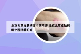 北京兒童皮膚病哪個醫(yī)院好 北京兒童皮膚科哪個醫(yī)院看的好