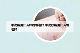 牛皮癬用什么樣的香皂好 牛皮膚癬用什么香皂好