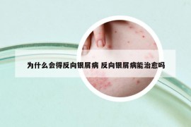 為什么會得反向銀屑病 反向銀屑病能治愈嗎