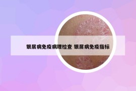 銀屑病免疫病理檢查 銀屑病免疫指標(biāo)