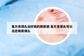復(fù)方青黛丸治好我的銀屑病 復(fù)方青黛丸可以治愈銀屑病么